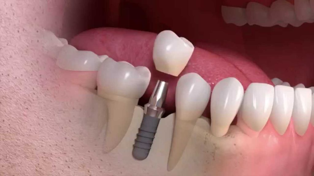 dental implants thomas ocheltree